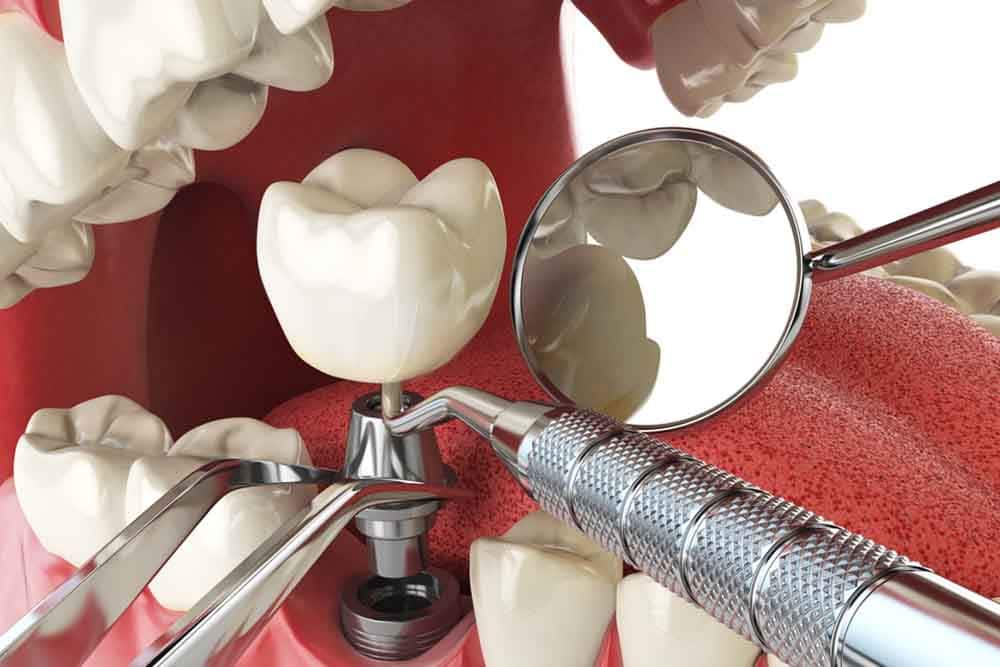 Implant - Preventative Dentistry