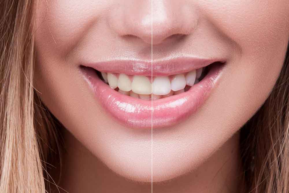 Whitening - Preventative Dentistry