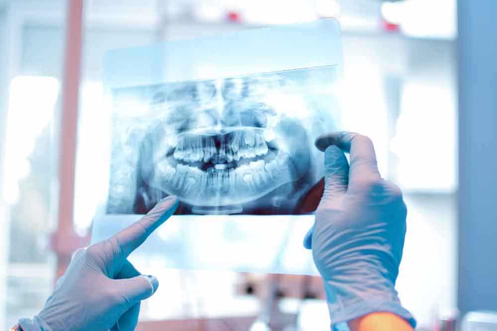 Teeth Xray - Preventative Dentistry